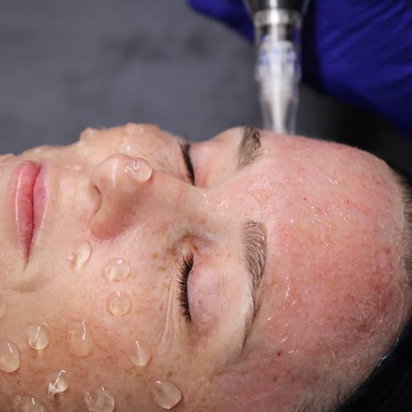 Close-up of a person receiving a facial treatment with water droplets on skin and a device on forehead.