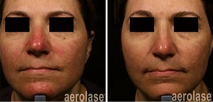 Side-by-side before and after images showing reduced facial redness after six Aerolase acne treatments.