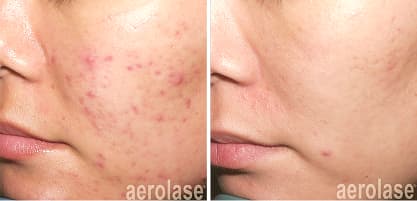 Side-by-side close-up of a cheek showing acne before and clearer skin after six treatments.