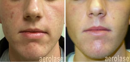 Aerolase acne before and after